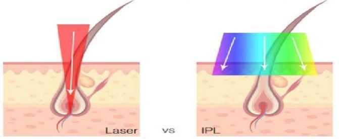 تفاوت بین لیزر و IPL